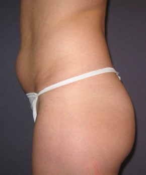 Liposuction