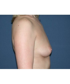 Before Image: Breast Augmentation After Pregnancy Volume Loss - other