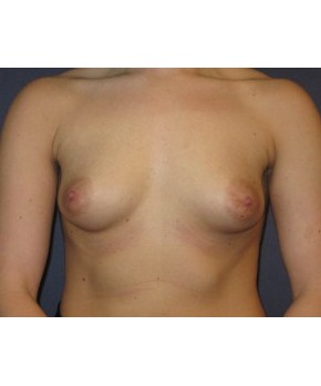 Before Image: Breast Augmentation Dense Breasts - front