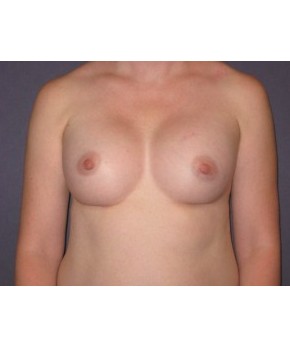 After Image: Breast Augmentation Dense Breasts - front