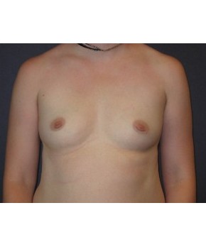 Before Image: Breast Augmentation Dense Breasts - front