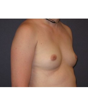Breast Augmentation Dense Breasts