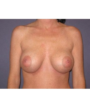After Image: Breast Augmentation Ptotic (Sagging) Breasts - front