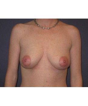 Before Image: Breast Augmentation Ptotic (Sagging) Breasts - front