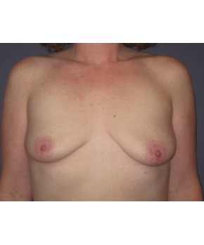 Before Image: Breast Augmentation Ptotic (Sagging) Breasts - front