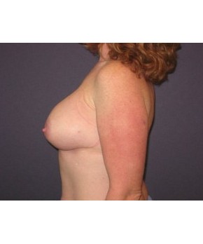 After Image: Breast Augmentation Ptotic (Sagging) Breasts - other