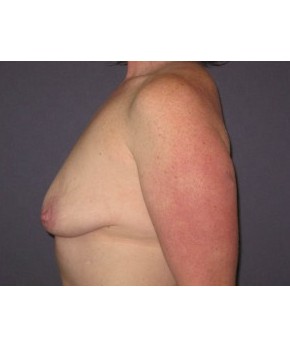 Before Image: Breast Augmentation Ptotic (Sagging) Breasts - other