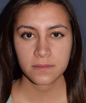 Rhinoplasty – Closed