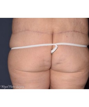 Massive Weight Loss – Abdominoplasty and Lateral Thigh Lift