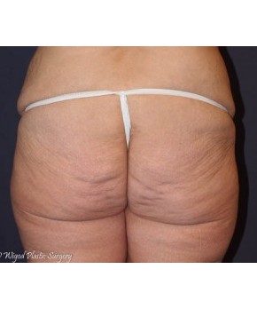 Massive Weight Loss – Abdominoplasty and Lateral Thigh Lift