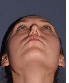 Rhinoplasty – Open with Functional Airway
