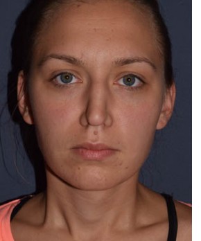 Rhinoplasty – Open with Functional Airway