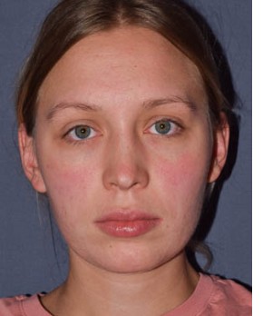 After Image: Rhinoplasty – Open with Functional Airway - front