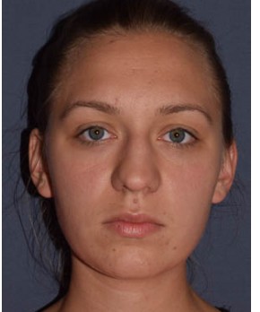 Before Image: Rhinoplasty – Open with Functional Airway - front