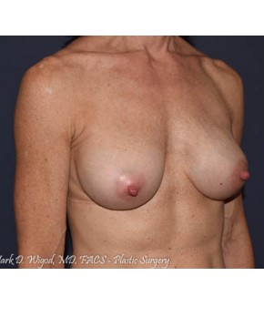 Breast Augmentation Revision