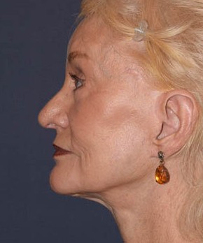 Facial Rejuvenation – Browlift