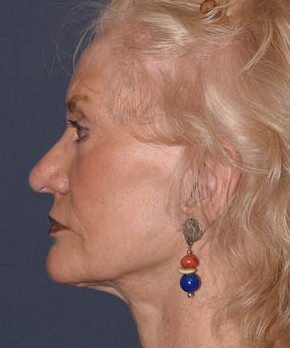 Facial Rejuvenation – Browlift