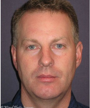 Rhinoplasty – Open with Chin Implant