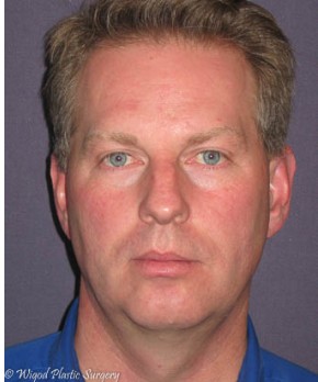 Rhinoplasty – Open with Chin Implant