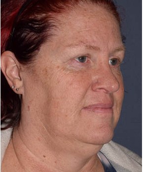 Rhinoplasty – Open with Functional Airway