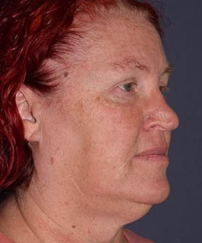 Rhinoplasty – Open with Functional Airway
