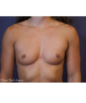 Before Image: Breast Augmentation – Body Builder / Fitness - front