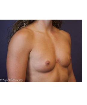 Breast Augmentation – Body Builder / Fitness