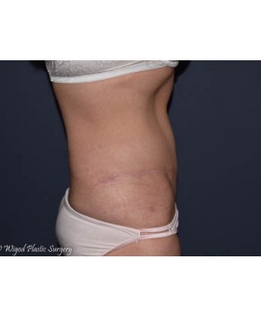 Abdominoplasty