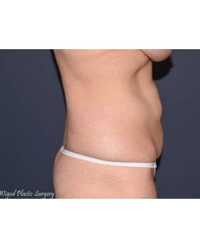Abdominoplasty