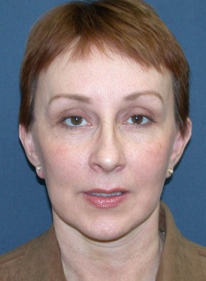 After Image: Facial Rejuvenation – Facelift and Browlift