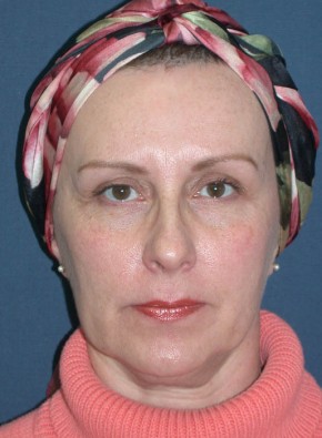 Before Image: Facial Rejuvenation – Facelift and Browlift