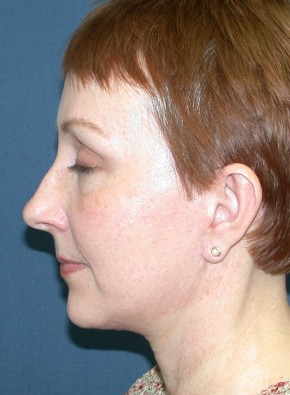 After Image: Facial Rejuvenation – Facelift and Browlift - other