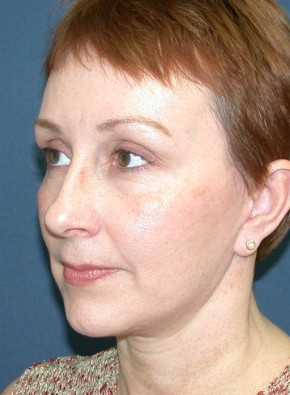 Facial Rejuvenation – Facelift and Browlift