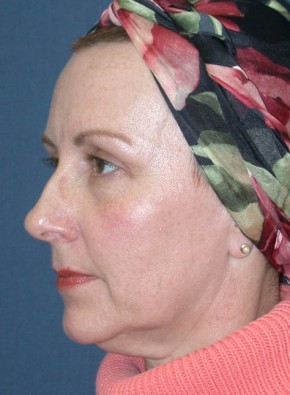 Facial Rejuvenation – Facelift and Browlift