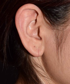 After Image: Ear Lobe Repair - front