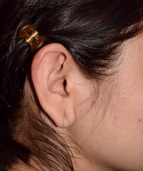 Before Image: Ear Lobe Repair - front