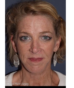After Image: Facial Rejuvenation – Facelift and Chin Implant - front