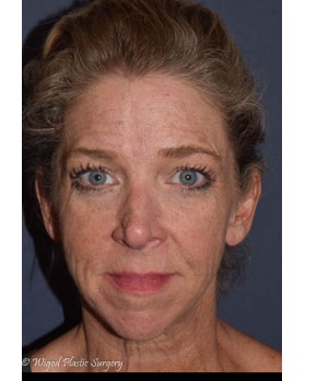 Before Image: Facial Rejuvenation – Facelift and Chin Implant - front