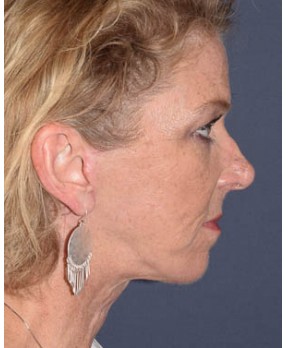 Facial Rejuvenation – Facelift and Chin Implant