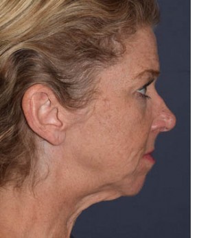 Facial Rejuvenation – Facelift and Chin Implant