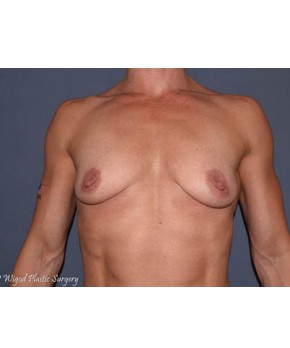 Before Image: Breast Augmentation – Body Builder / Fitness - front
