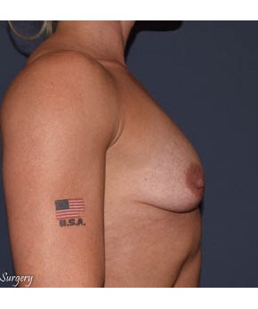 Breast Augmentation – Body Builder / Fitness