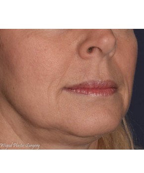 After Image: Facial Reconstruction Lip - front