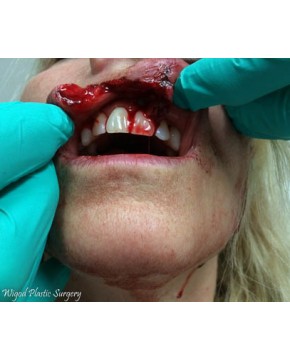 Before Image: Facial Reconstruction Lip - front
