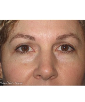 Facial Rejuvenation – Upper Blepharoplasty (eyelid lift)