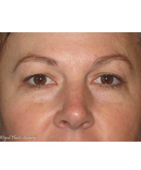 Facial Rejuvenation – Upper Blepharoplasty (eyelid lift)