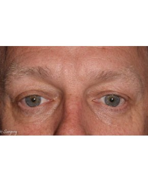 Facial Rejuvenation – Lower Blepharoplasty