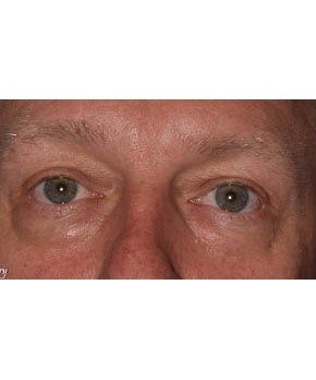 Facial Rejuvenation – Lower Blepharoplasty