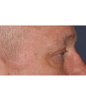 Facial Rejuvenation – Lower Blepharoplasty