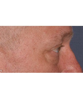 Facial Rejuvenation – Lower Blepharoplasty